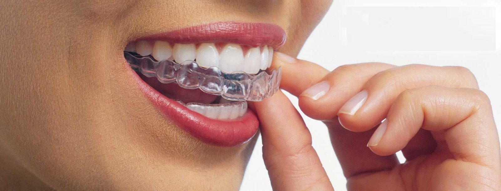 Invisalign braces