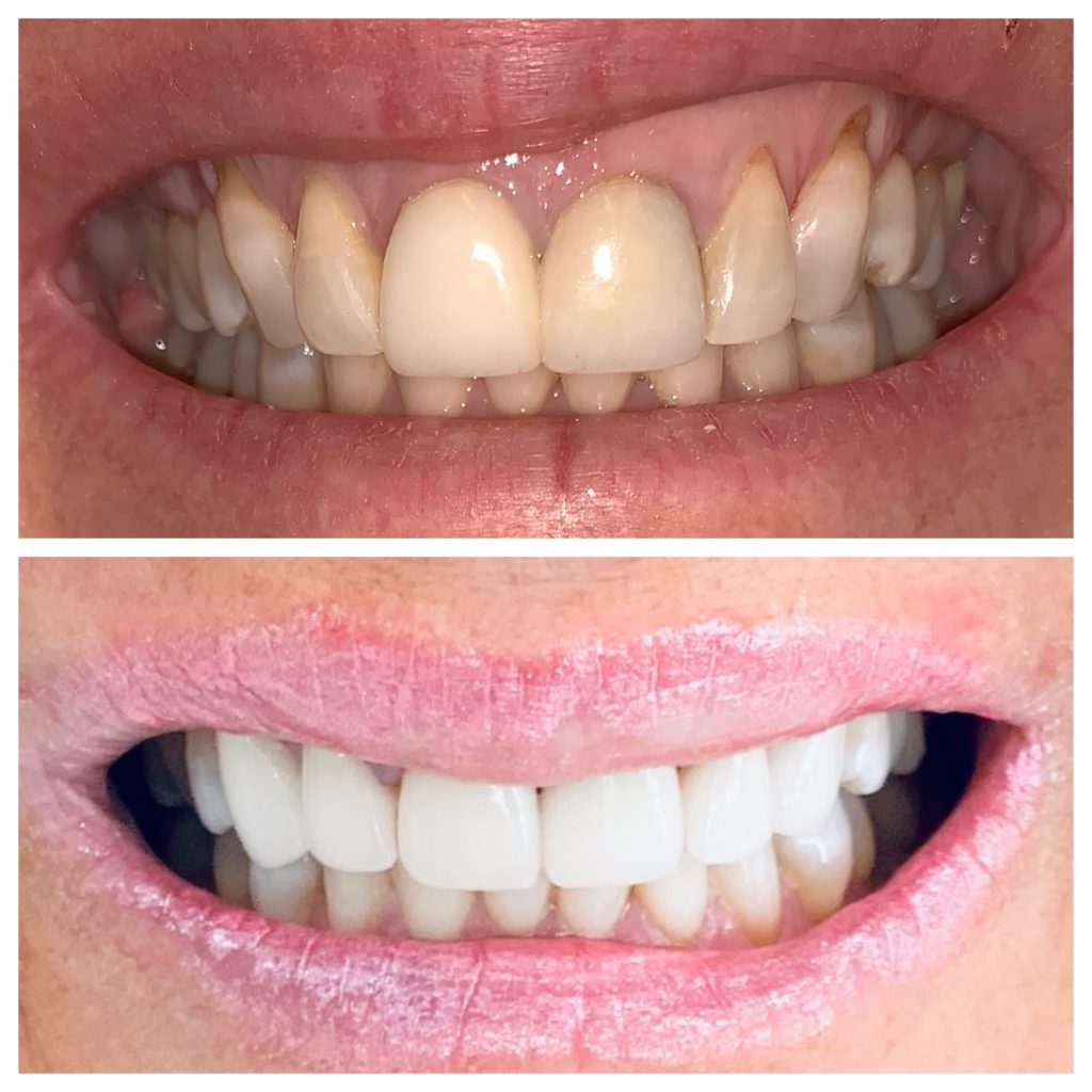 Affordable Cosmetic Dentistry Veneers Service Sher Dental