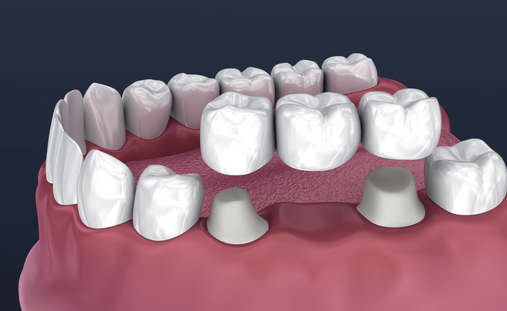 Tooth Replacement In Acworth, Ga