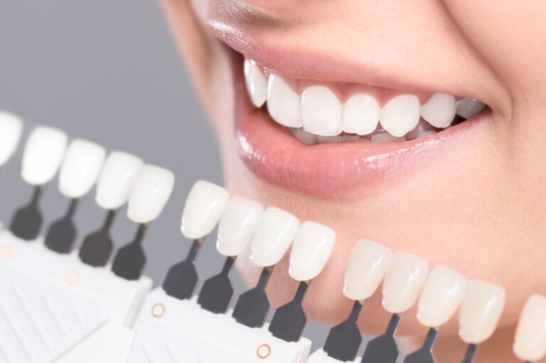 4 Top Types Of Teeth Whitening Services Available In Miami