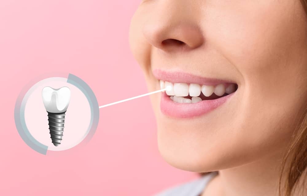 Dental implants north miami