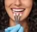 veneers in Aventura FL