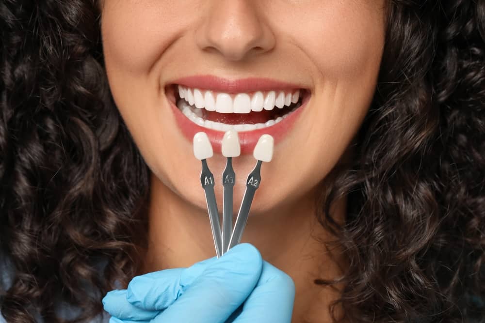 veneers in Aventura FL