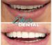 WhyVeneers and Smile Makeovers Are Popular in Miami 2025