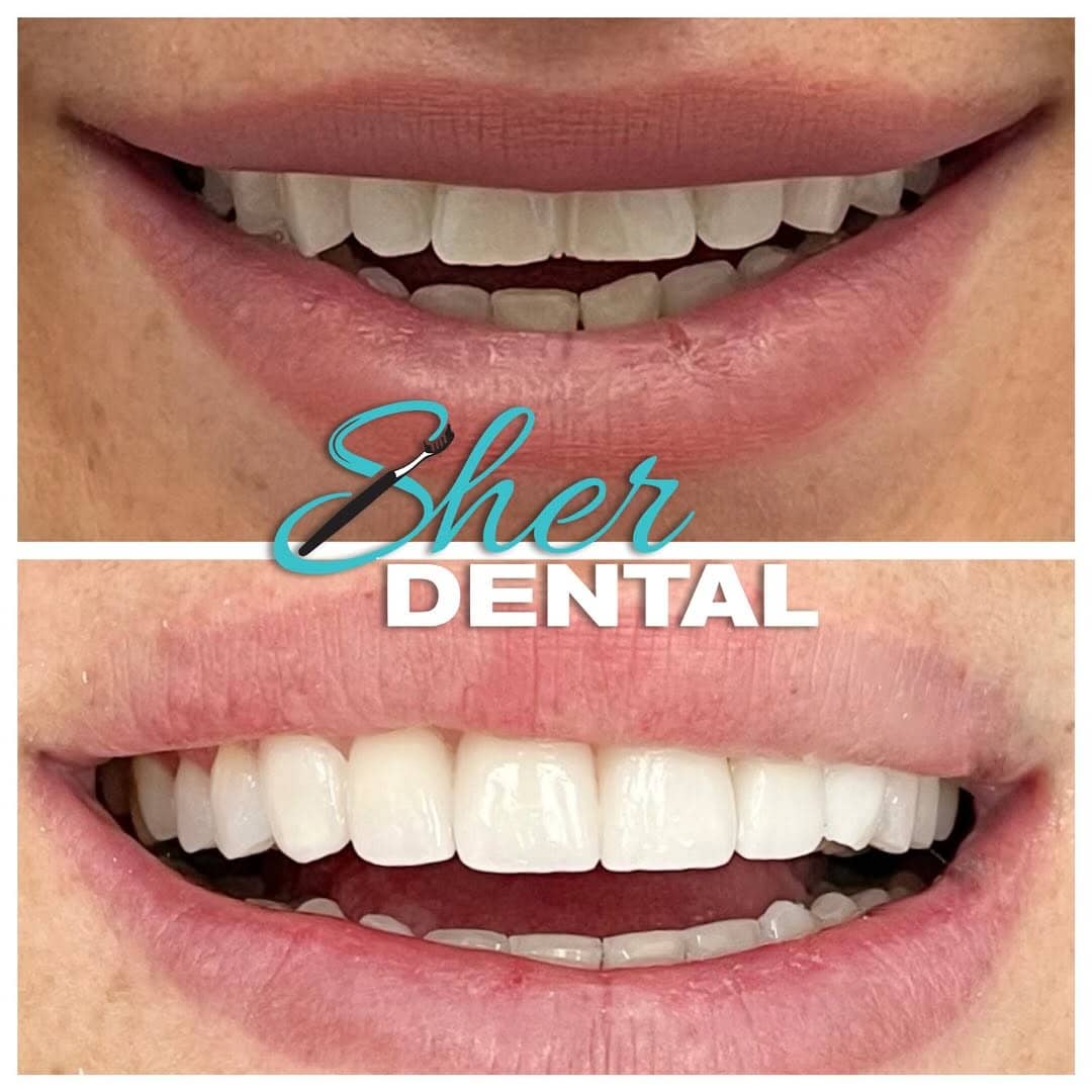 WhyVeneers and Smile Makeovers Are Popular in Miami 2025