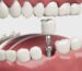 Dental Implants Aventura FL