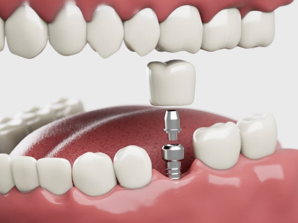 Dental Implants Aventura FL