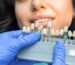 Veneers Fort Lauderdale