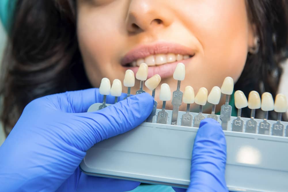 Veneers Fort Lauderdale