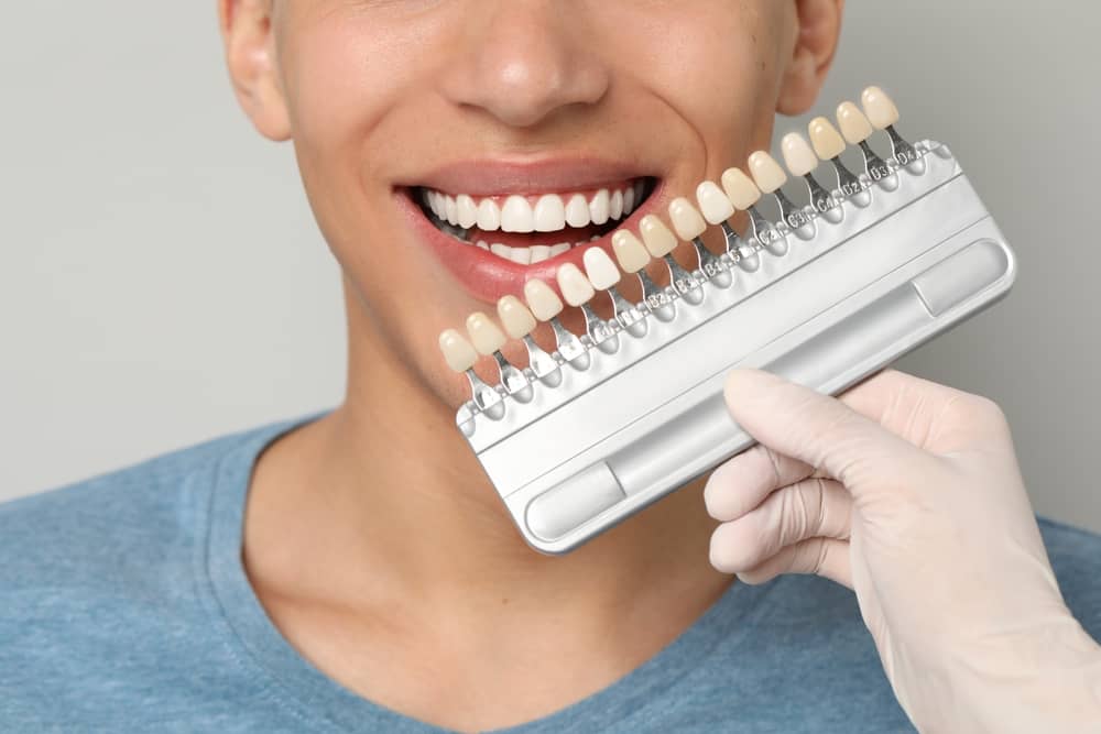 Veneers in Fort Lauderdale