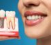dental implants aventura fl
