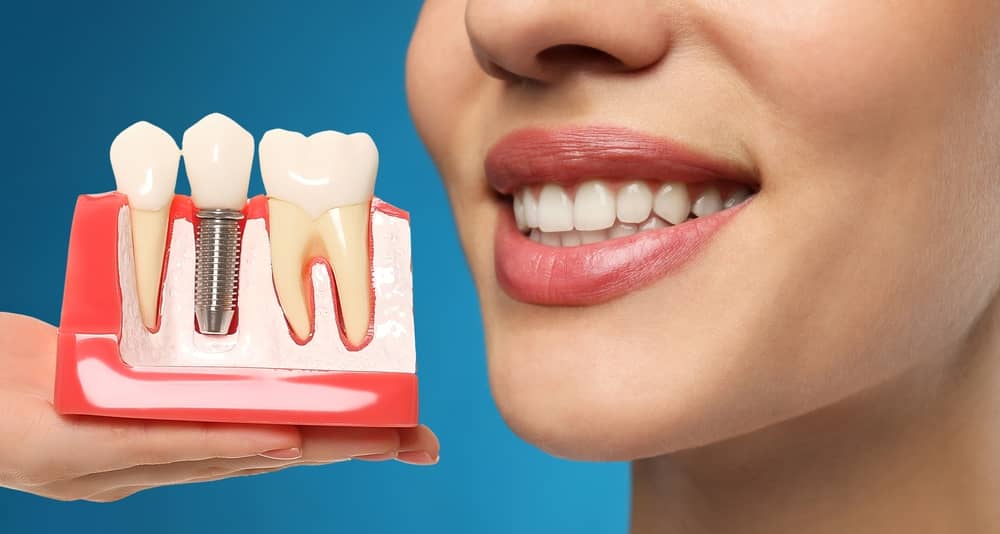 dental implants aventura fl