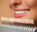 Porcelain veneers in Fort Lauderdale