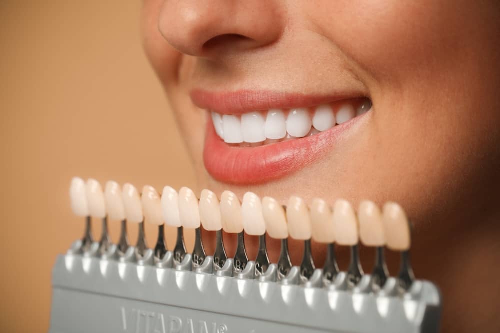 Porcelain veneers in Fort Lauderdale