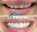 dental implants in Miami FL