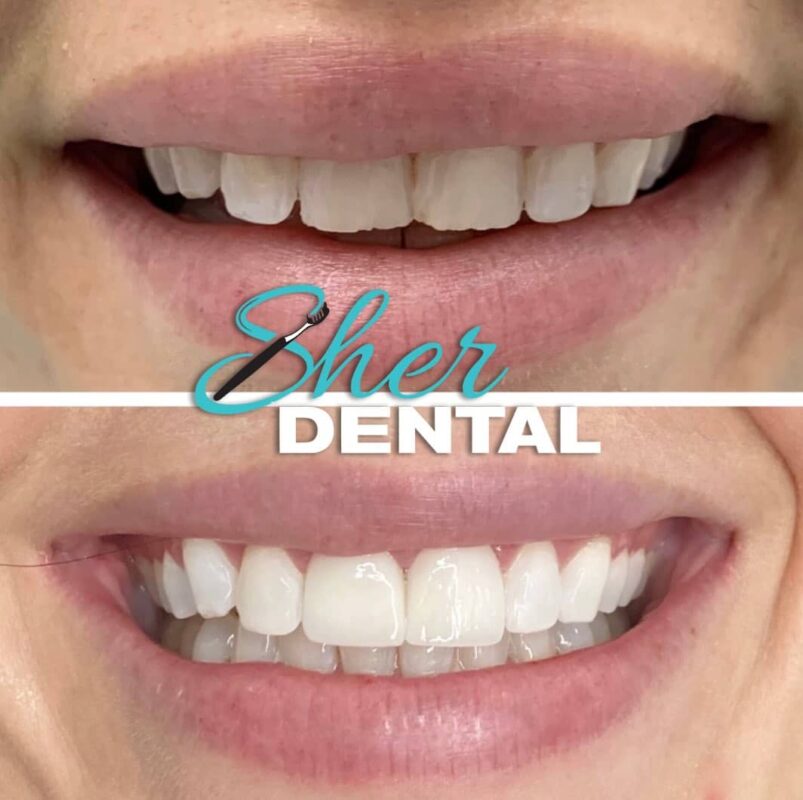 dental implants in Miami FL
