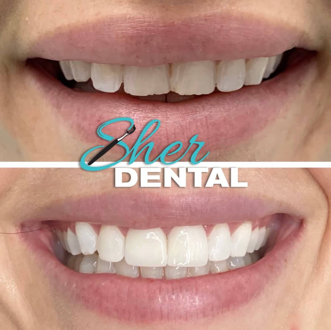 dental implants in Miami FL