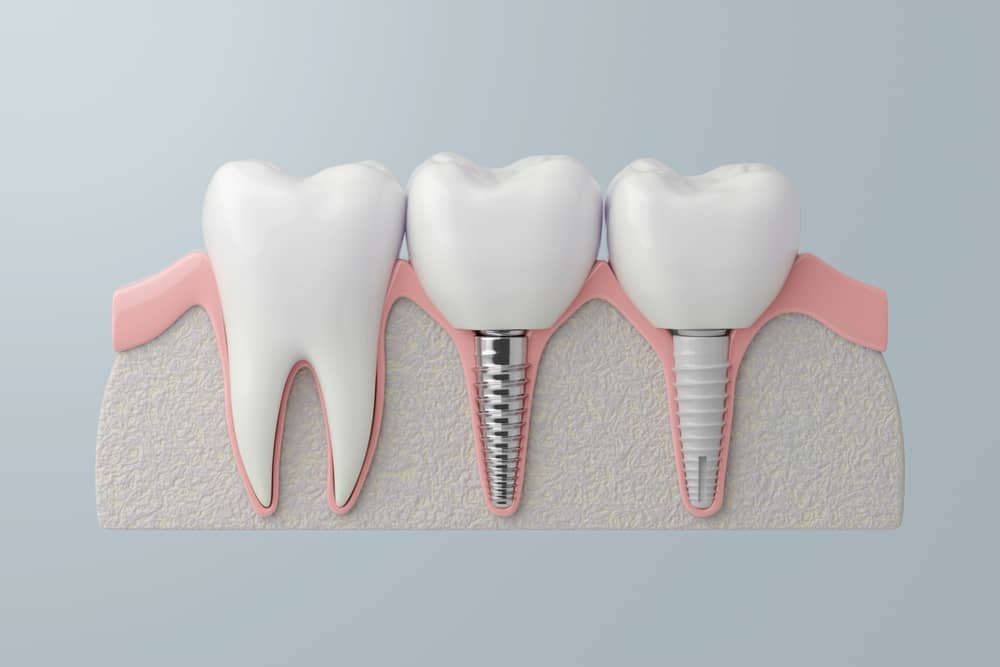 Dental Implants