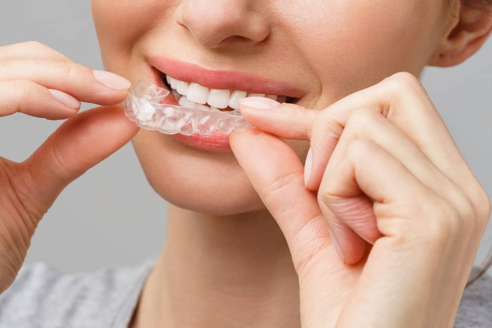clear aligners in North Miami